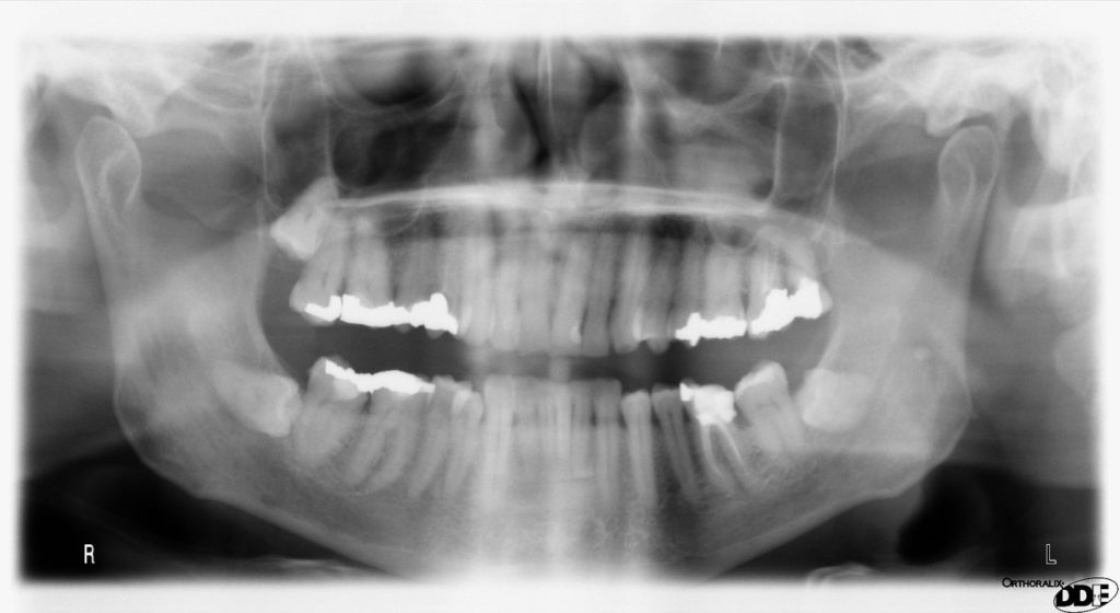 x-ray of wisdom teeth