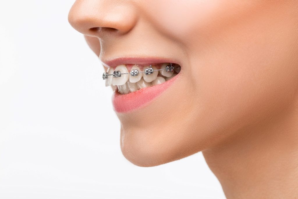 Detailed side look at braces